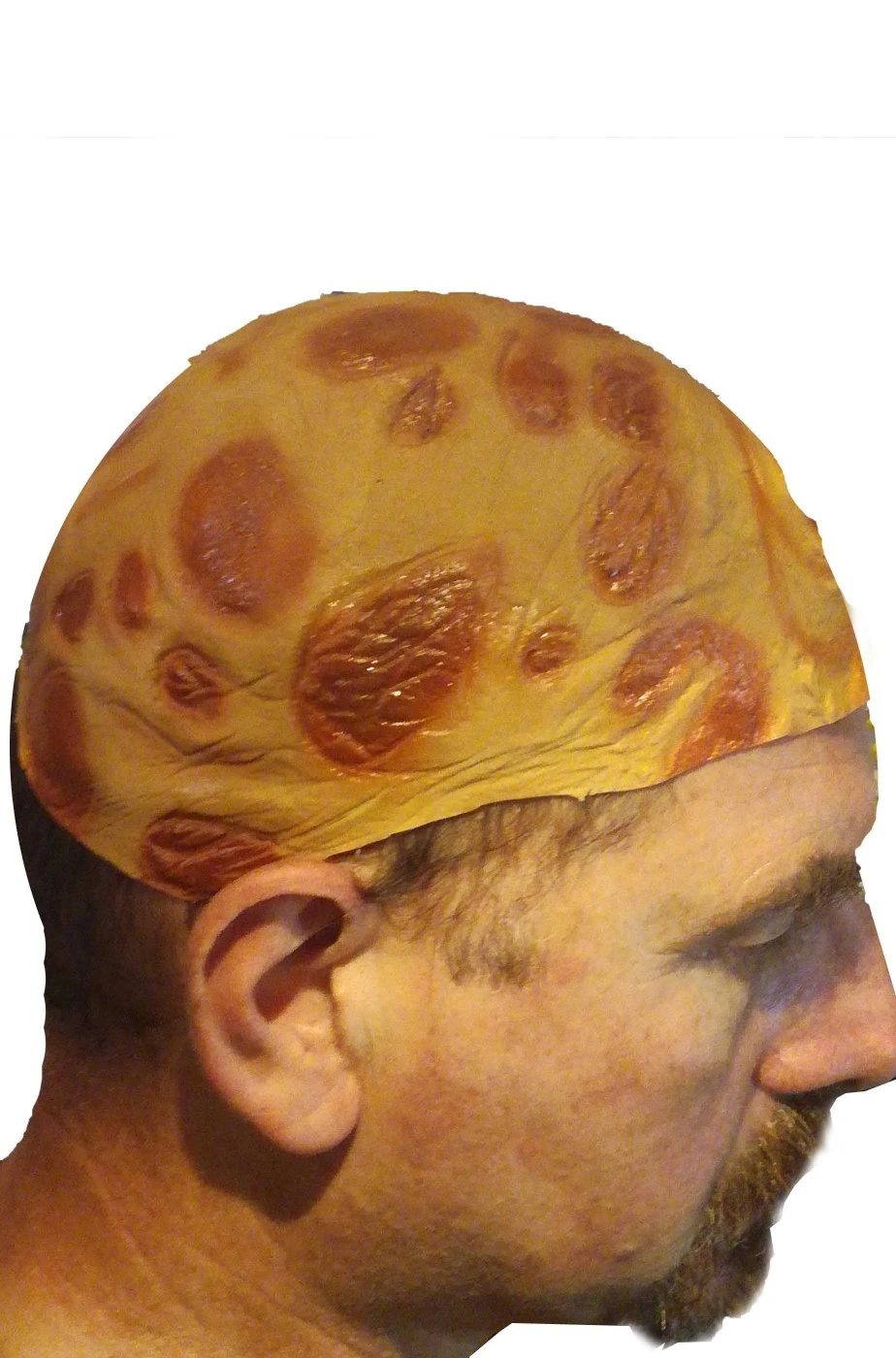 Calotta In Lattice Per Calvo Con Ustioni E Cicatrici - immagine 2