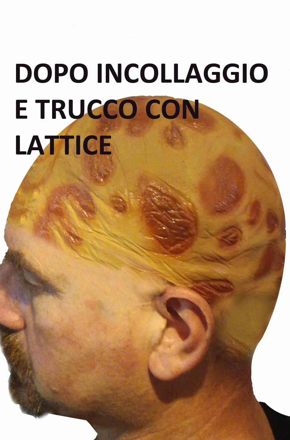 Calotta In Lattice Per Calvo Con Ustioni E Cicatrici - immagine 4